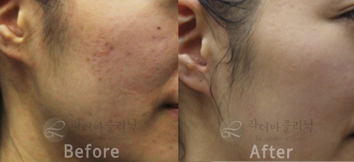 색소 더마필 3회 전후사진